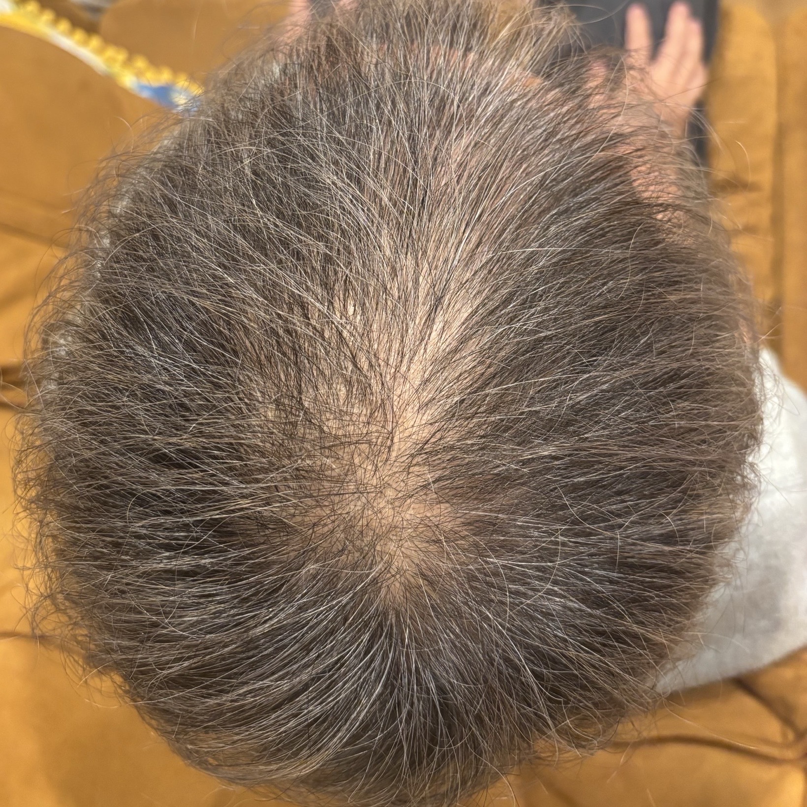頭皮ケアの施術前の写真